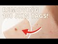 100 Skin Tags Removed from My Neck – 2 Weeks Before & After ft. Q Esthetics