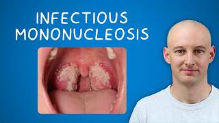 Infectious Mononucleosis (Glandular Fever) - Essential GP Revision