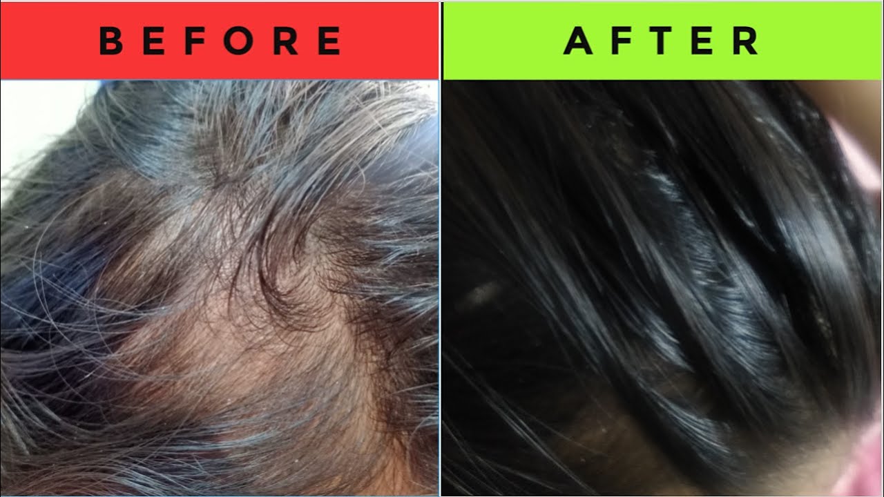 APPLY THIS DOUBLE HAIR GROWTH MASK ON THIN HAIR | HAIR MASK WITH CURD