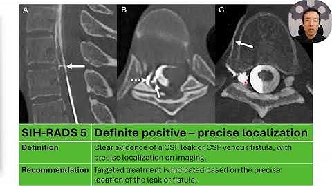 SIH-RADS: Structured Reporting for CSF Leaks in Dynamic CT Myelography