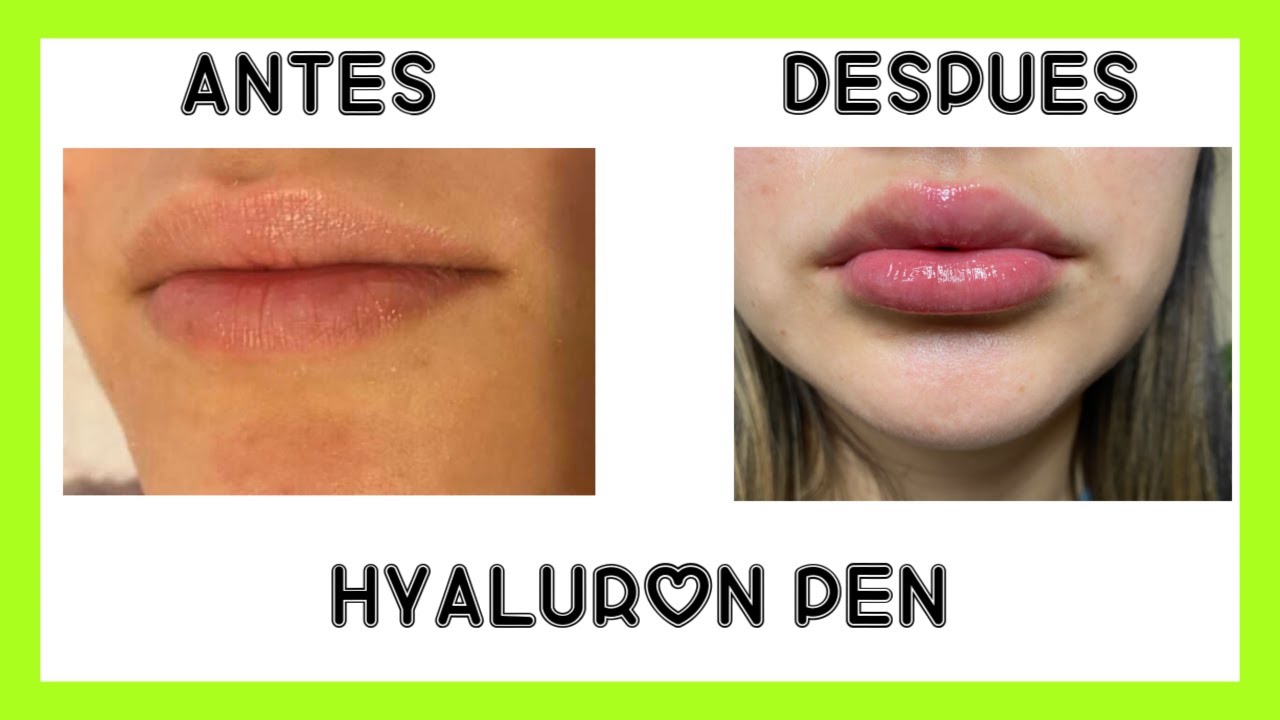 HYALURON PEN UN CAMBIO EN MIS LABIOS + PROCEDIMIENTO YouTube