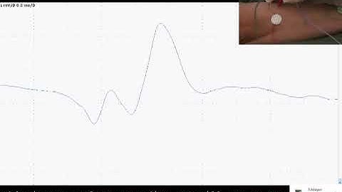 SFEMG - Stimulation EDC  (Joze Trontelj)