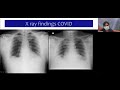 ICU Care in COVID-19 (2 of 3): Management of the critically ill COVID patient