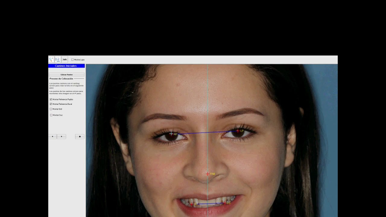 DSD (Digital Smile Design) con Nemostudio