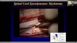 Nuances in the Care of Spinal Cord Ependymoma - Mark E. Shaffrey, M.D.