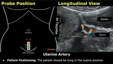 How To Scan The Uterine Artery | Doppler Ultrasound Probe Positioning | Transducer Placement USG
