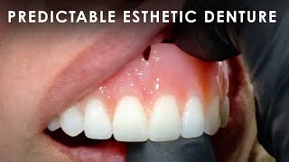 Creating the Most Predictable Esthetic Denture