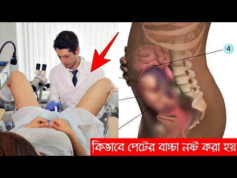 এব্রোশন এর মাধ্যমে কিভাবে পেটের বাচ্চাকে নষ্ট করা হয় ? জানলে আপনার বিবেক নাড়া দিবে।nobodut