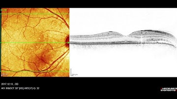 Optical coherence tomography shows Retina Disease, Central serous retinopathy, OD Movie 2017.12.13