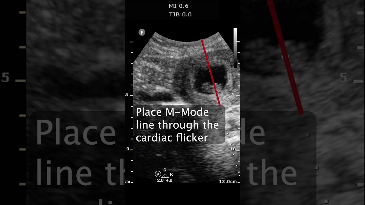 How To Measure A Fetal Heart Rate In The 1st Trimester POCUS Ultrasound Emergencymedicine OBGYN