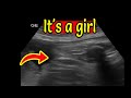 Ultrasound Showing Baby Girl