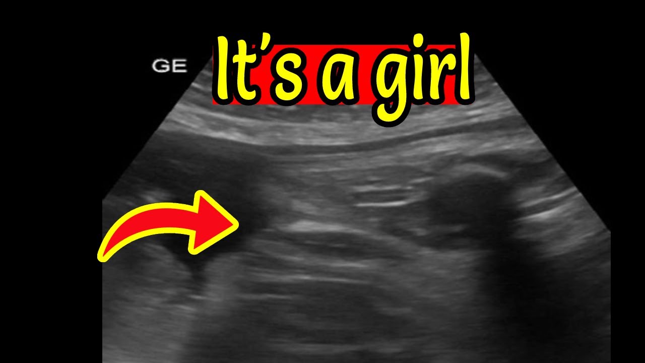 Ultrasound Showing Baby Girl YouTube Ultrasound Showing Baby Girl YouTube