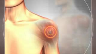 Лечение артроза плечевого сустава. Ударно-волновая терапия (УВТ)(Техника лечения артроза плечевого сустава с помощью ударно-волновой терапии (УВТ). Безоперационный метод., 2014-08-30T11:12:44.000Z)