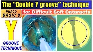 The Double Y groove technique for Difficult Soft Cataracts - Dr. Deepak Megur screenshot 4