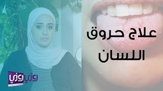 علاج حروق اللسان