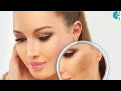WHAT IS MELASMA - CAUSES, TREATMENT, AND PREVENTION