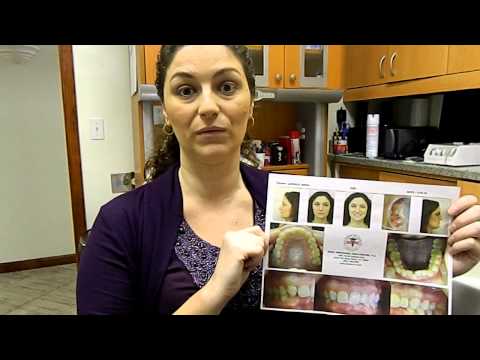chronic-headache-cure-with-tmj-treatment-and-braces.mov