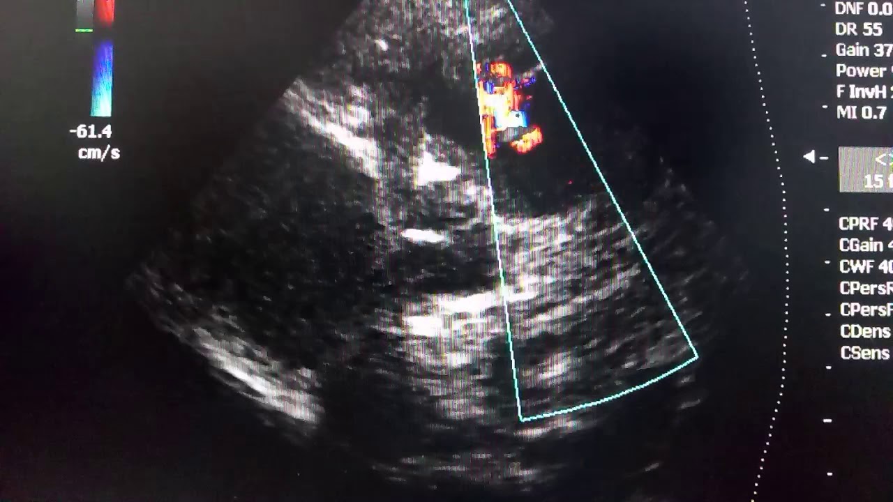 Открытый артериальный проток, Синдром Эйзенменгера