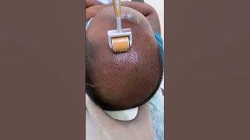 Thumbnail of PRP - Best hair loss treatment | Hair loss treatment | derma roller hair regrowth | Skinaa Clinic
