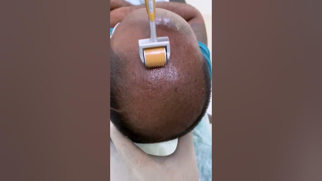 PRP - Best hair loss treatment | Hair loss treatment | derma roller hair regrowth | Skinaa Clinic