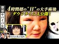 女子高生の術後2日目のリアル!腫れ・痛み・変化を大公開!【整形サバイバル#1 | DT報告】