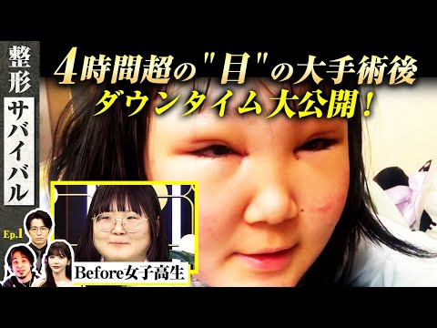 女子高生の術後２日目のリアル！腫れ・痛み・変化を大公開！【整形サバイバル#1 | DT報告】