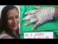 Meet | First woman to receive fish skin treatment