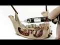 Children's Dental Injection Technique (Mandibular Block for Pediatric Patients at Tebo Dental)