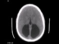 Colpocephaly CT