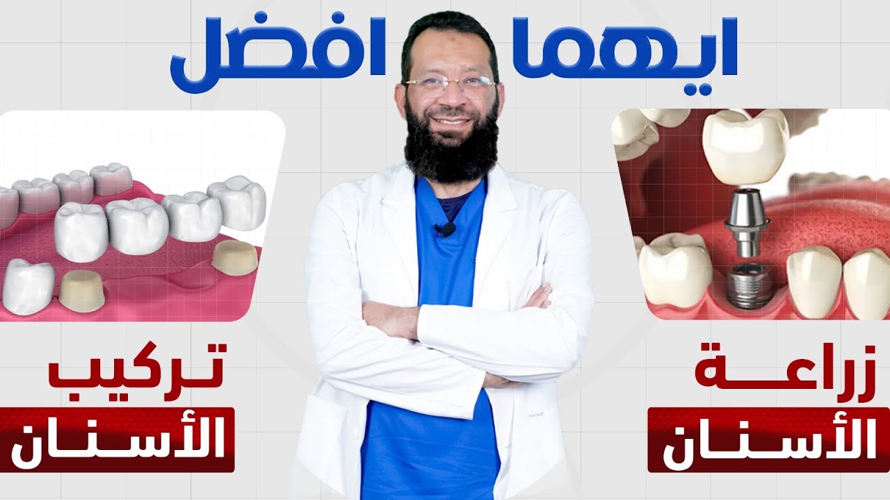الفرق بين تركيب الاسنان وزراعة الاسنان | د. حمدي العوضي