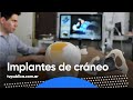 Implantes de cráneo con diseño argentino -  Aire Nacional