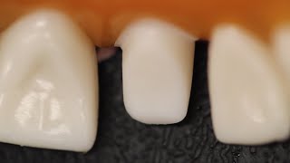 All Ceramic Crown Anterior Tooth Preparation