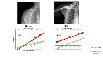Shoulder Arthroplasty | Orthopedic Applications for DDR | Konica Minolta