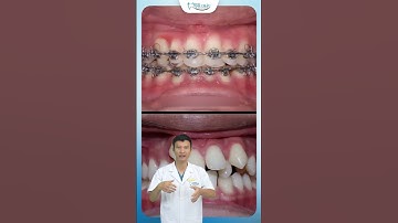 Sự Di Chuyển Răng Lệch Lạc Khi Niềng | Bác Sĩ Yên