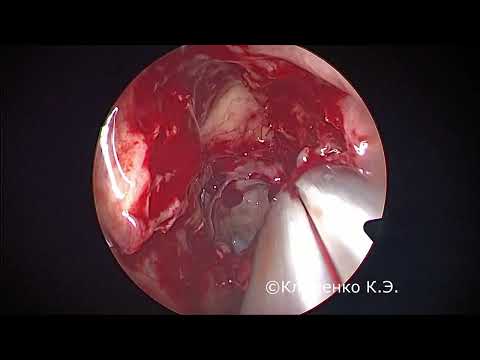 Эндоскопическая фронтотомия слева. Endoscopic frontal sinus surgery.