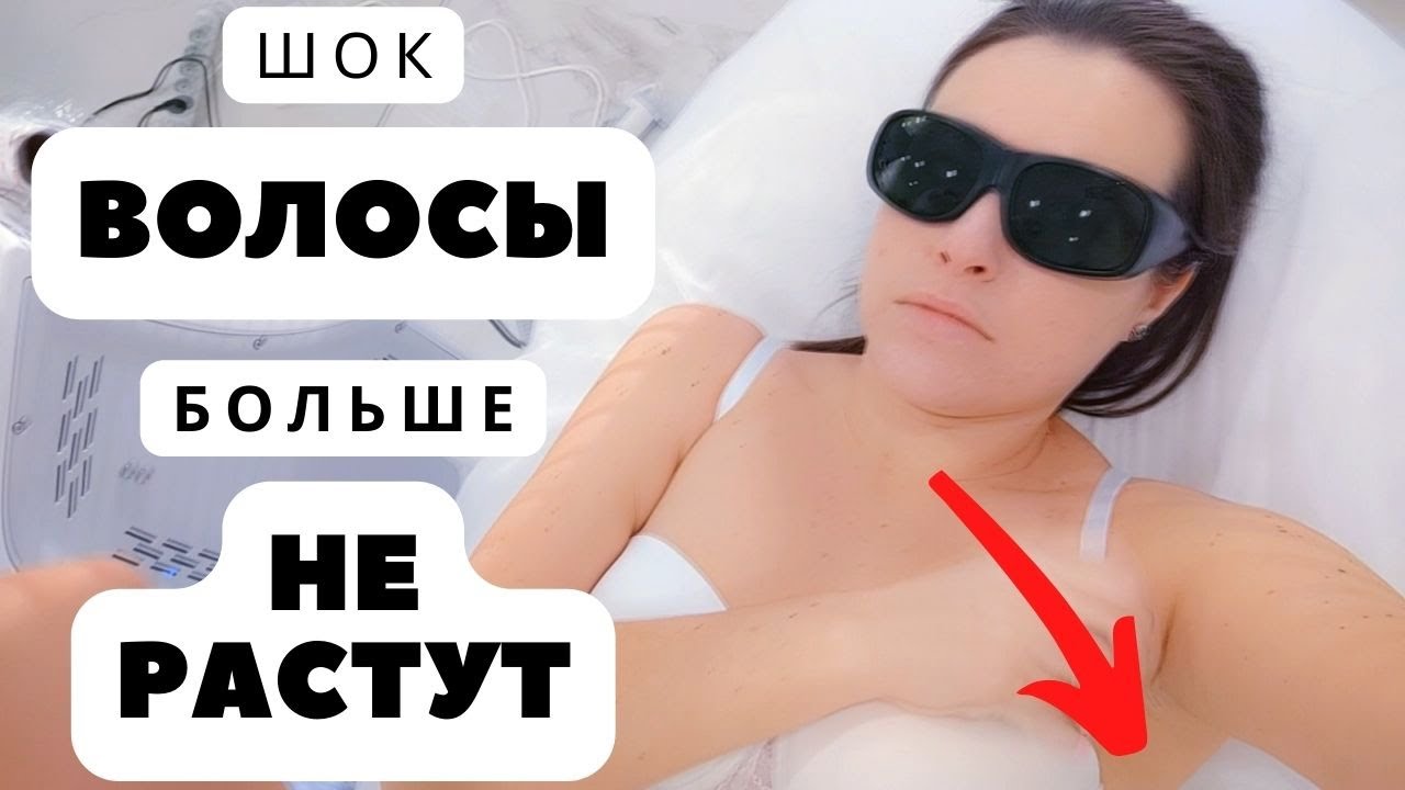 ШОК. Волосы БОЛЬШЕ не РАСТУТ. ЛУЧШАЯ студия ЛАЗЕРНОЙ эпиляции. - YouTube