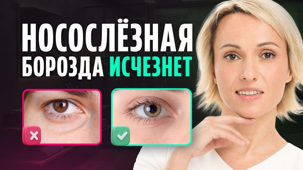Эти 2 приема БЫСТРО убирают НОСОСЛЕЗНУЮ БОРОЗДУ / Результат вас удивит!