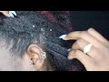 FLAKY DRY SCALP | SCRATCHING DANDRUFF Ep25 #dandruff #scalpraking