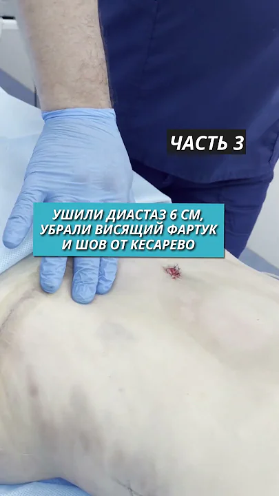 Вернули красивую грудь и сделали плоский живот после 3-х родов | Часть 3