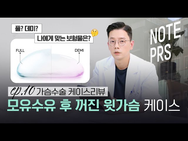 [가슴리뷰] 모유수유 후 l 윗가슴이 꺼진 케이스 l 모티바