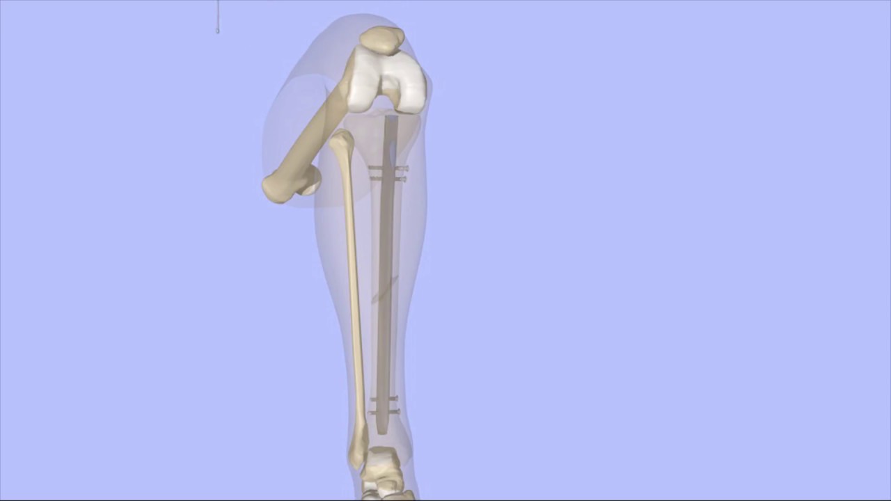 Intramedullary Nailing System,Intramedullary Nailing Of Fractures | Trauma