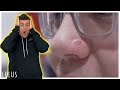 Emergency Nose Piercing Troubleshoot *Swollen*| Ep  390