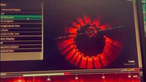 Optical Coherence Tomography | OCT in PCI | The Future of Angioplasty & Stent Implantation is Here!