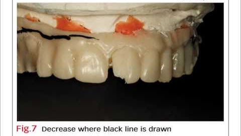 Bench Mastery: Full-mouth hybrid fused to titanium
