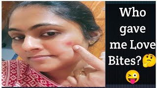 Guess Who Is Giving Me Love Bites On My Face??