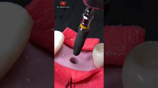 Tooth implant procedure (Step by tep)