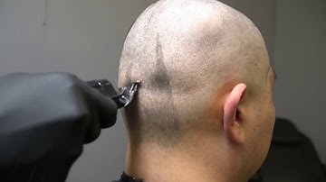 Scalp Micro Pigmentation First Session