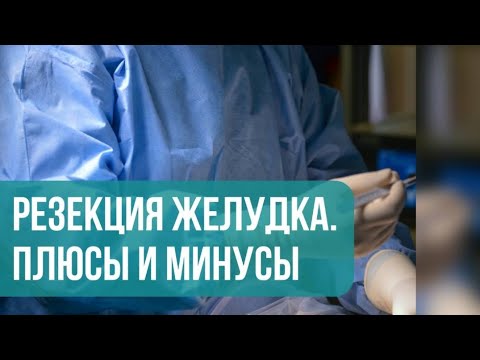 Продольная резекция желудка. Плюсы и минусы