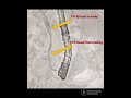 "ERCP FOR CHRONIC CALCIFIC PANCREATITIS WITH PD STRICTURE"