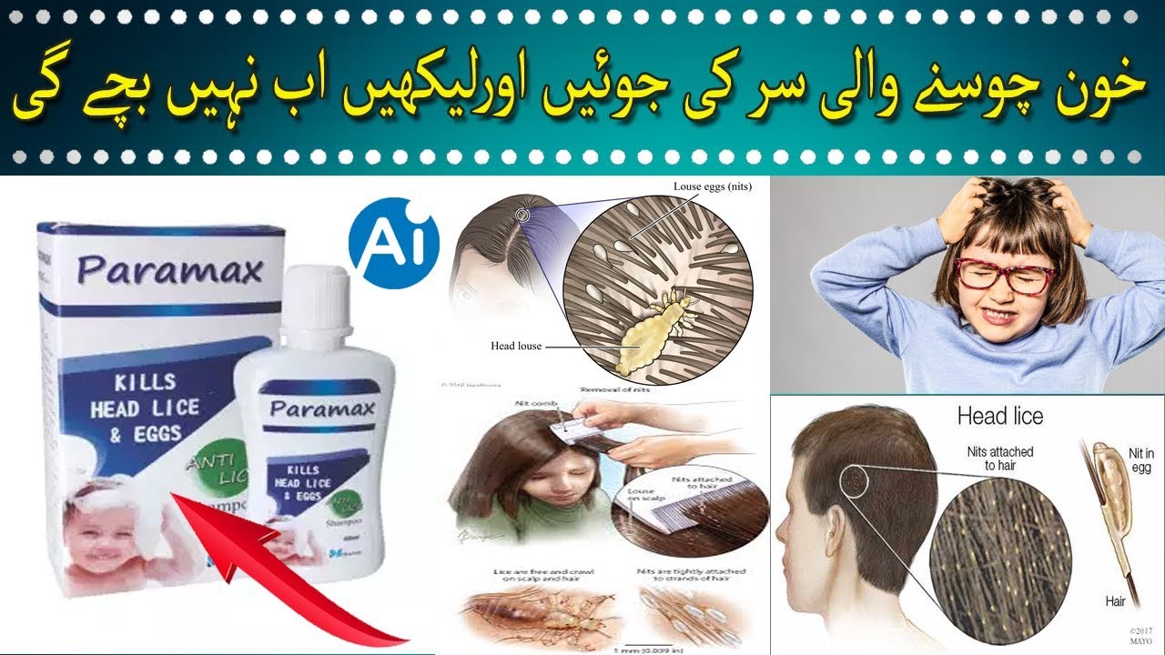 Get Rid Of Head Lice Nits Naturally 100 Result In Urdu Hindi